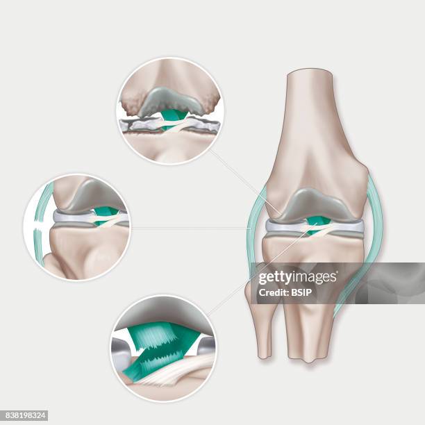 Illustration of various knee pathologies. From top to bottom: osteoarthritis of the knee, sprain with a torn lateral ligament, dislocation, and torn...