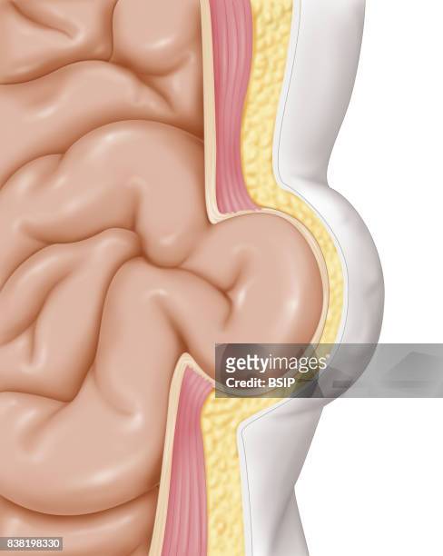 Cross-section illustration of an abdominal hernia, intra-abdominal tissue protruding through the weak areas of the abdominal lining.