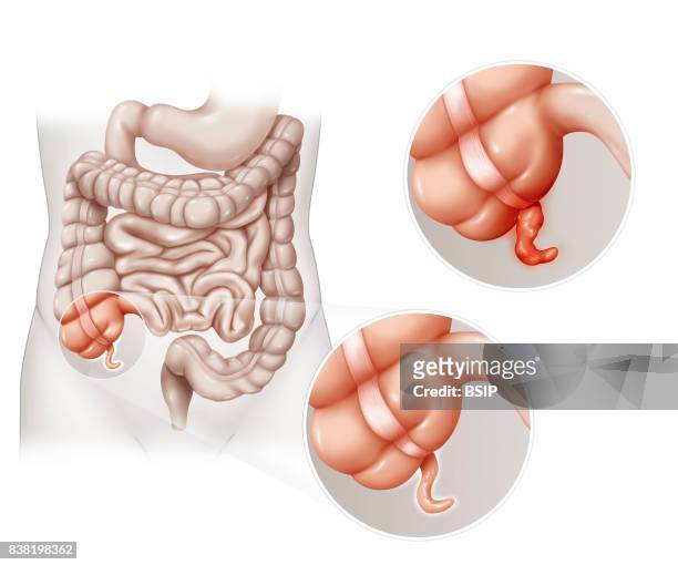 Illustration of appendicitis, acute inflammation of the appendix, a natural diverticulum, a prolongation of the caecum, between the small intestine...