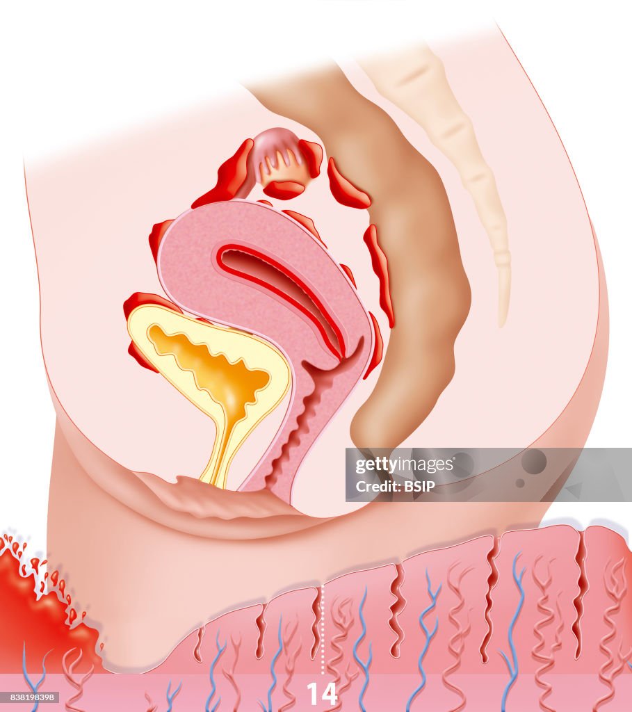 Endometriosis, illustration