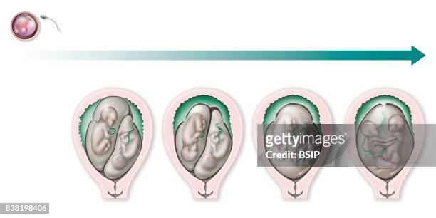 Illustration of various types of uniovular gemellary pregnancies, true twins); these pregnancies result from a single egg and a single sperm, the...