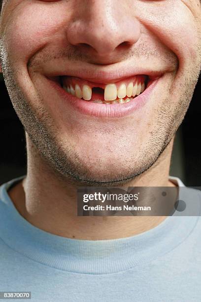 young man with a missing tooth - spleetje stockfoto's en -beelden