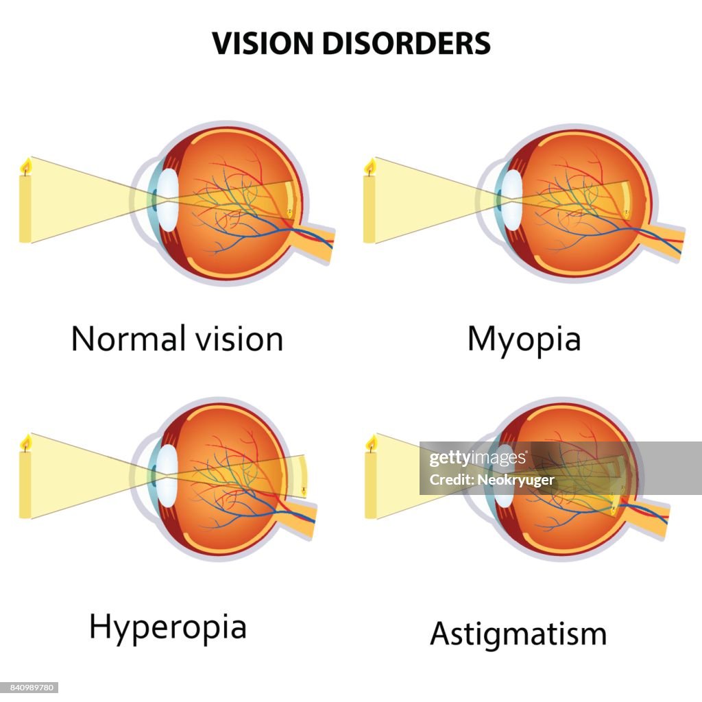 Common Vision Example Common Vision Disorders High-Res Vector Graphic - Getty Images
