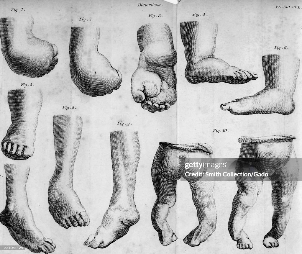 Medical illustration showing various deformities of the foot and
