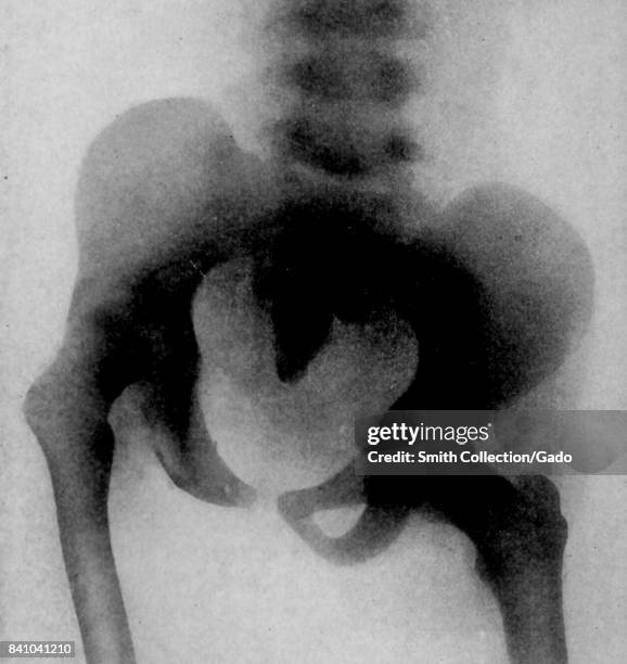 Raw of the pelvis of a patient affected by tuberculosis of the hip joint, showing wandering of the acetabulum and shortening of three inches, 1903....