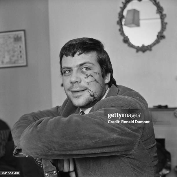 English actor Oliver Reed appears with his face scratched, as a result of a brawl in a pub, UK, 9th April 1964.