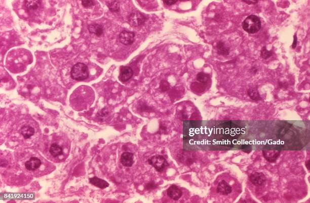This micrograph shows human hepatocytes infected with the Ebola virus, 1977. The Ebola pathogen is a member of the Filoviridae family of RNA viruses....