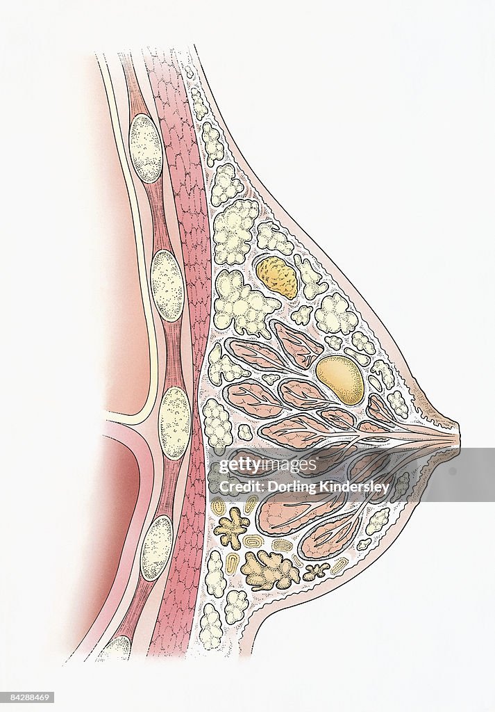 Illustration showing cyst, fibroadenoma,and fibrocystic disease in cross section of human breast
