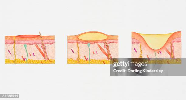 illustration of blistering second degree burn in epidermis and dermis in three cross sections of human skin - skin cross section stock illustrations