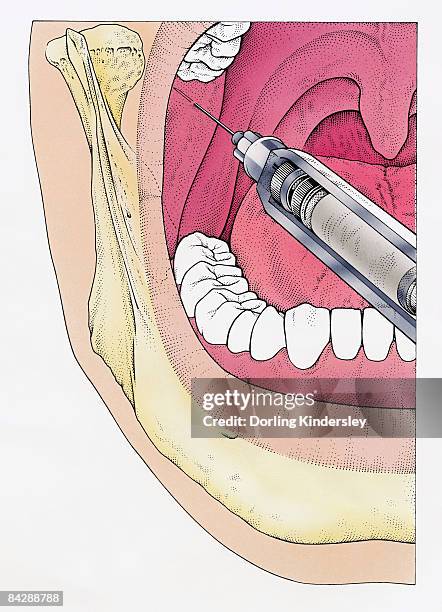 illustration of injecting open human mouth using syringe seen in cross section showing jaw bone, teeth and epiglottis - epiglottis stock-grafiken, -clipart, -cartoons und -symbole