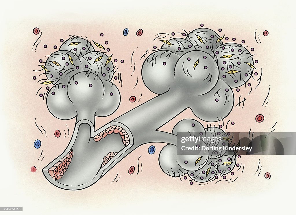Illustration of bronchus and alveolus covered in inorganic particles, fibroblasts,and growth factor obstructing the internal lining