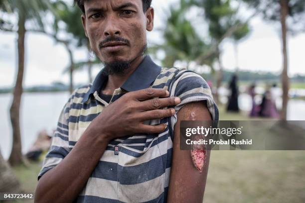 Kalimullah is a tractor driver who fled from recent violence in Myanmar, shows his lesion hand as the Burmese military shot him. Teknaf, Bangladesh,...