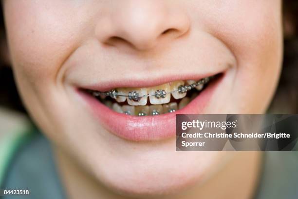 close up mouth with brace - braces and smiles fotografías e imágenes de stock