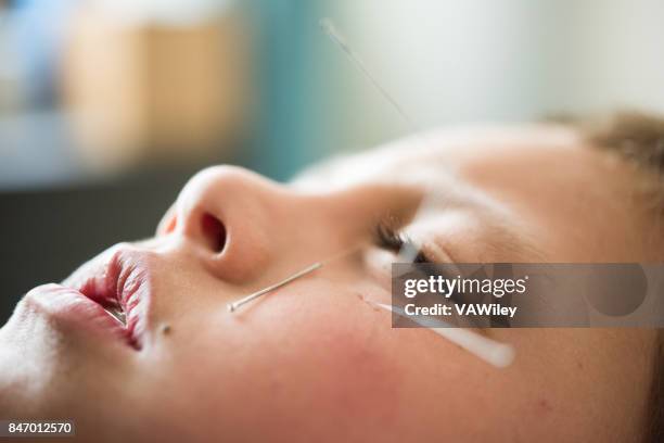 child getting acupuncture by a professional - acupuncture needle stock pictures, royalty-free photos & images