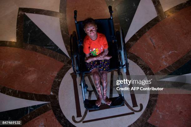 Shalini Yadav known as the "snake girl" poses in Marbella on September 15, 2017. Shalini, who suffers recessive lamellar ichthyosis and sheds her...