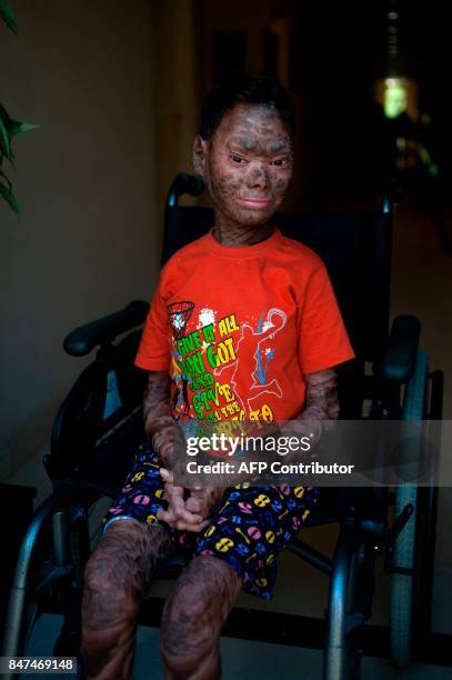 Shalini Yadav known as the "snake girl" poses in Marbella on September 15, 2017. Shalini, who suffers recessive lamellar ichthyosis and sheds her...