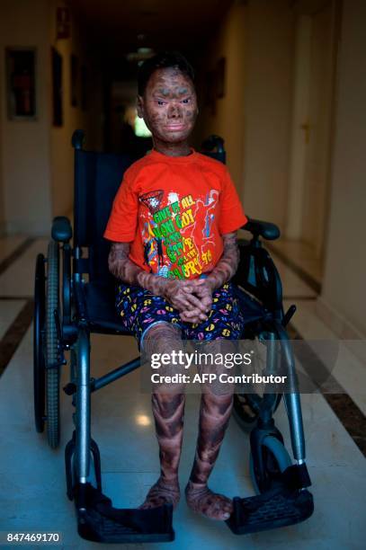 Shalini Yadav known as the "snake girl" poses in Marbella on September 15, 2017. Shalini, who suffers recessive lamellar ichthyosis and sheds her...