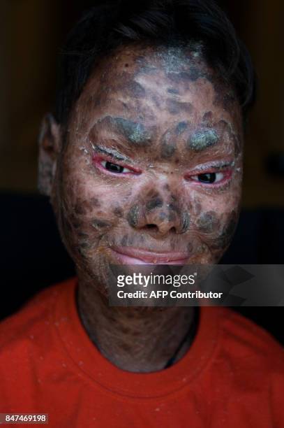 Shalini Yadav known as the "snake girl" poses in Marbella on September 15, 2017. Shalini, who suffers recessive lamellar ichthyosis and sheds her...