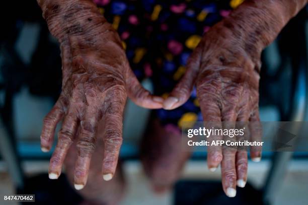 The hands of Shalini Yadav known as the "snake girl" are pictured in Marbella on September 15, 2017. Shalini, who suffers recessive lamellar...