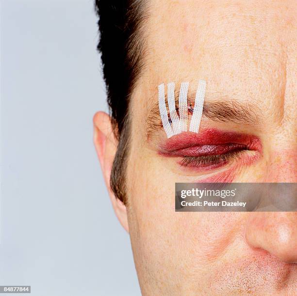 street crime victim eyes closed with stitches - domestic violence men stock pictures, royalty-free photos & images