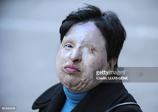 Ameneh Bahrami poses on March 5, 2009 in Barcelona. Bahrami, of Iran, was blinded by a man who threw acid in her face. In 2008 an Iranian court ruled...