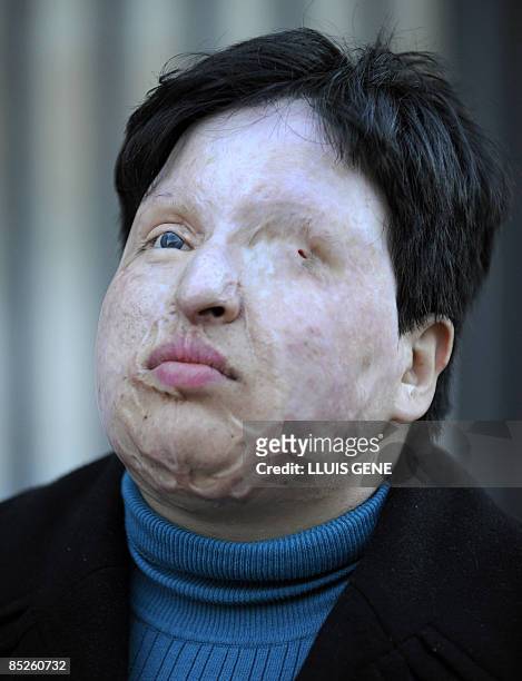 Ameneh Bahrami poses on March 5, 2009 in Barcelona. Bahrami, of Iran, was blinded by a man who threw acid in her face. In 2008 an Iranian court ruled...