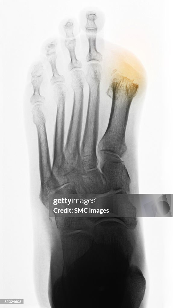 X-ray diabetic foot with toe amputations