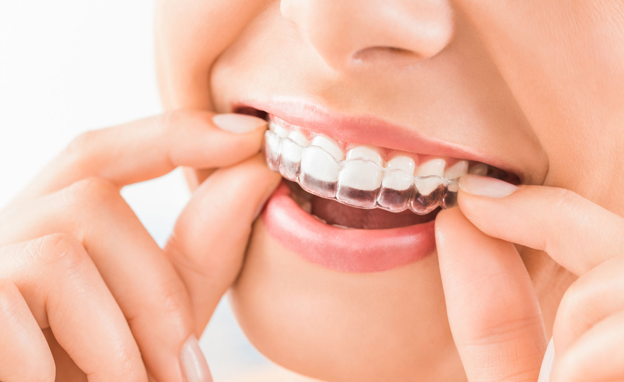aligners care