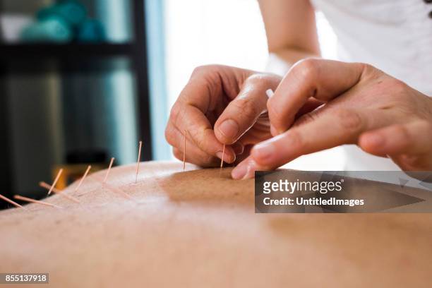 woman having acupuncture treatment - acupuncture stock pictures, royalty-free photos & images