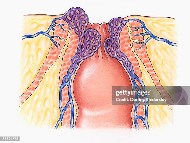 cross section illustration of human anal column showing external and internal sphincters, healthy veins, and internal and external haemorrhoids causing inflammation of rectum and anus veins - external digestion stock illustrations