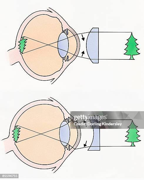 cross section illustrations of human eyes with concave and concave lenses looking at green tree - convex lens stock illustrations