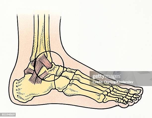 illustration of child's ankle showing torn anterior talofubular ligament - ankle sprain stock illustrations