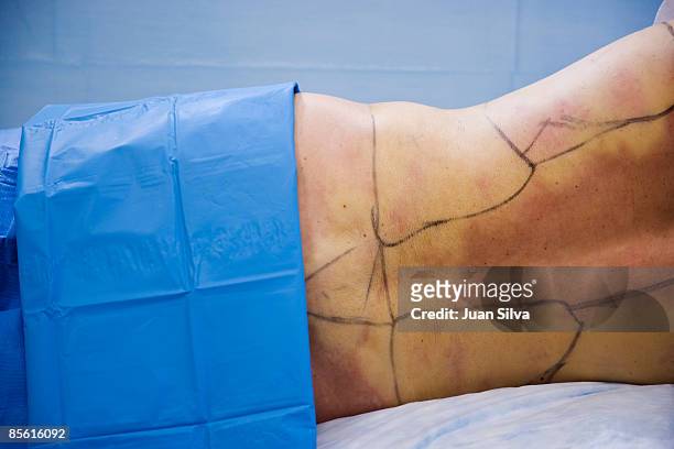 woman's body marked with pen, ready for liposuctio - west palm beach stock pictures, royalty-free photos & images