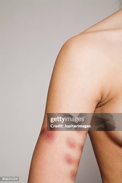 woman with bruises on arm - prellung stock-fotos und bilder