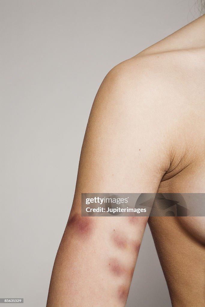 Woman with bruises on arm