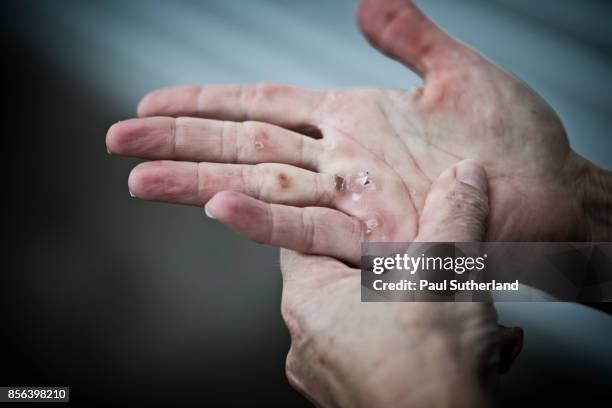 mature female woman rowing hands with blisters - blister stockfoto's en -beelden