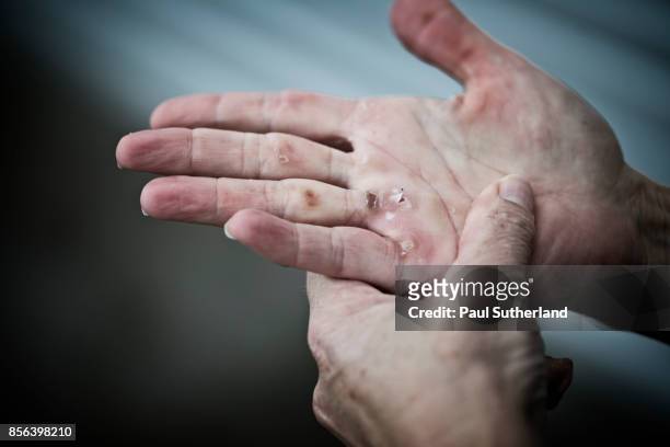 mature female woman rowing hands with blisters - blister stock pictures, royalty-free photos & images
