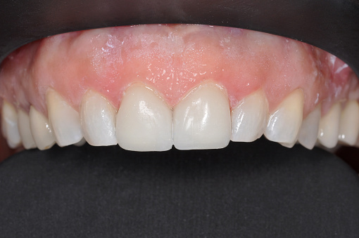 Teeth Row Close Up Of A Patients Upper Row Of Teeth At A Dental Clinic High-Res ...