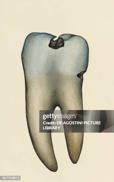 Molar affected by tooth decay, human body, drawing.