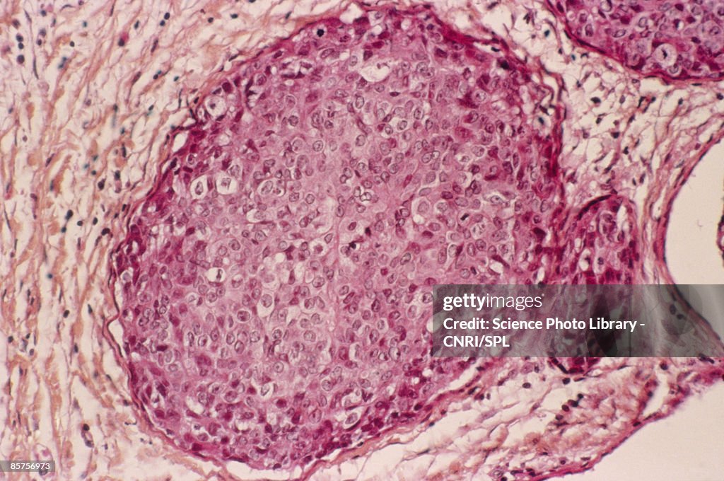 Light micrograph of section through breast tissue showing adenocarcinoma