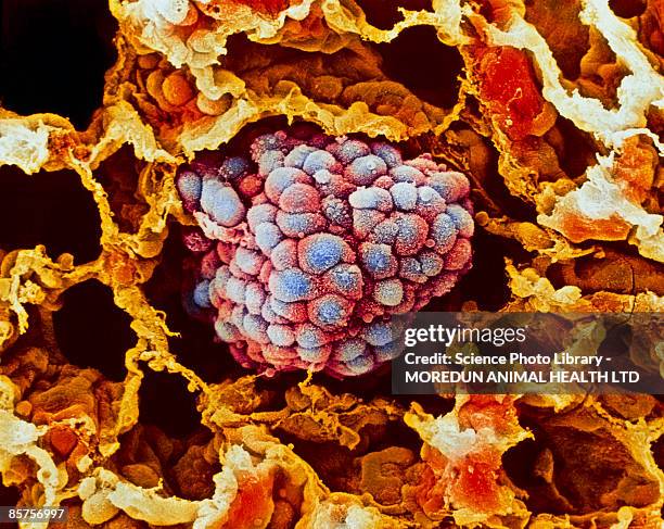 lung cancer, close-up - poumon humain photos et images de collection