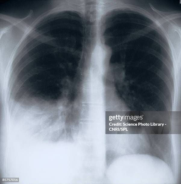 x-ray image of chest - neumonía fotografías e imágenes de stock