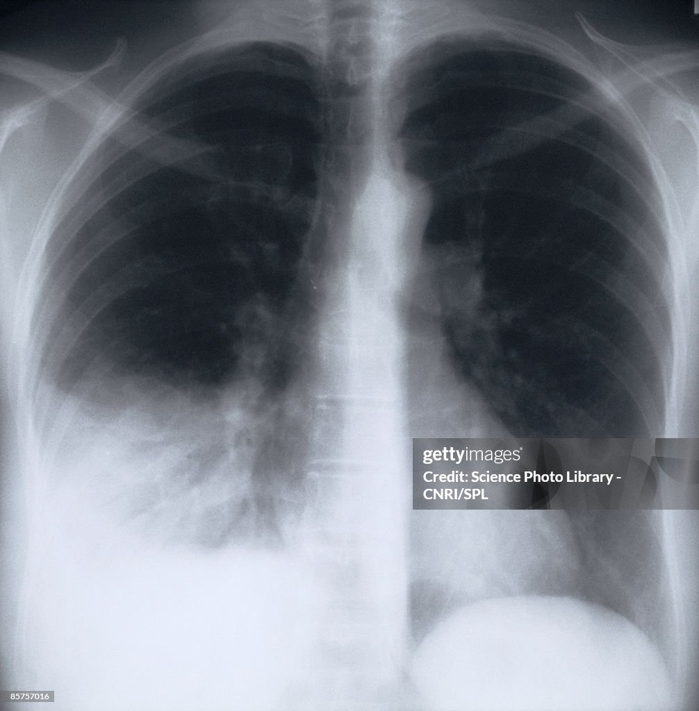 X-ray image of chest