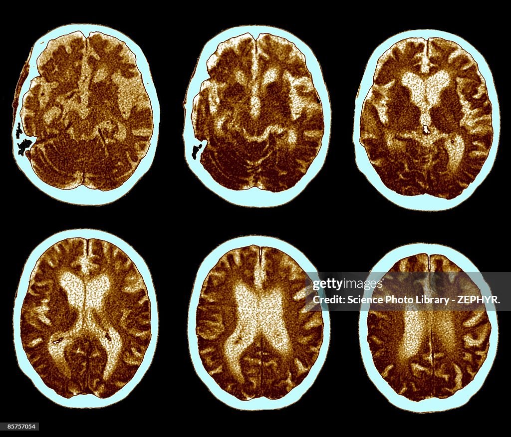 CAT scan of brain, Alzheimer's disease