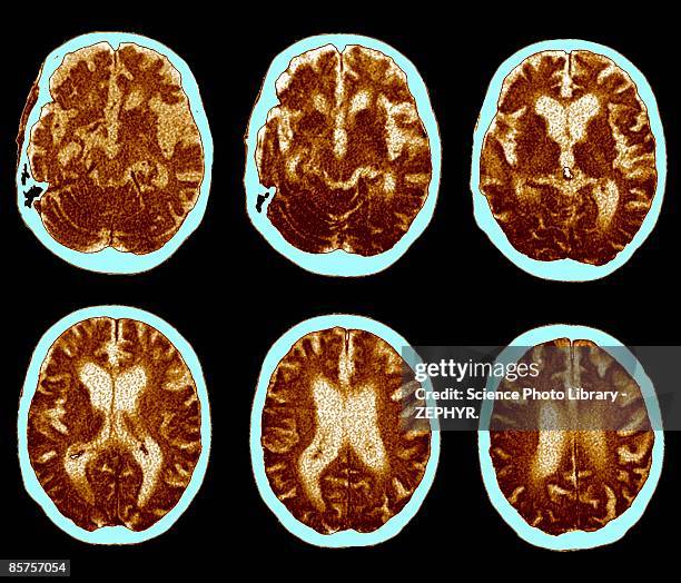 cat scan of brain, alzheimer's disease - 老人痴呆症 個照片及圖片檔