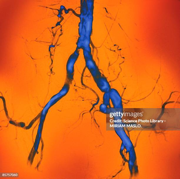 narrowed abdominal arteries, colored angiogram - coronary artery stock pictures, royalty-free photos & images