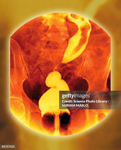 rectal cancer - barium stock pictures, royalty-free photos & images
