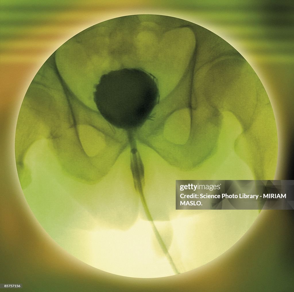 Normal bladder, colored cystogram