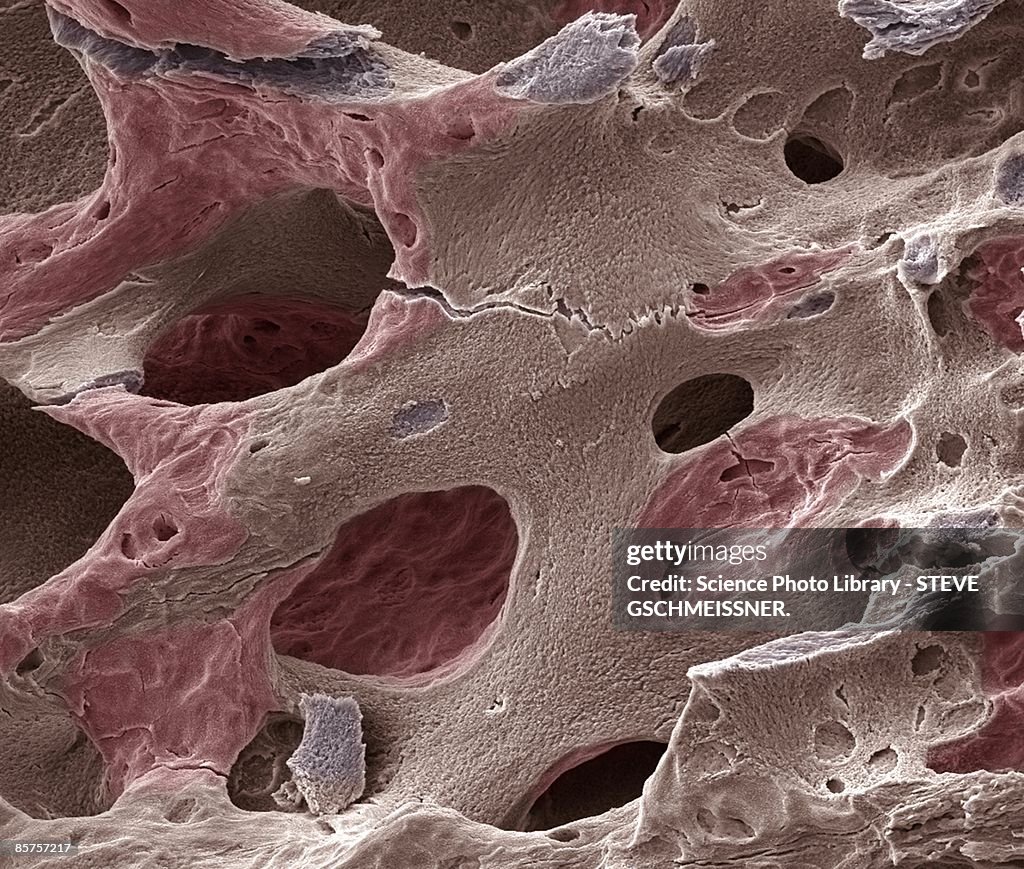 Scanning electron micrograph (SEM) of human bone, osteoporosis