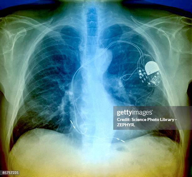 Gi Pacemaker 1,507 Pacemaker Images Stock Photos, High-Res Pictures, and Images ...